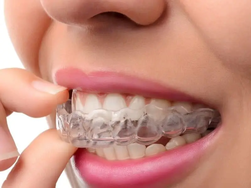 Home Picture of a female inserting clear aligner trays into her mouth