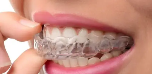 Appliance Therapy A patient inserting a clear orthodontic aligner.