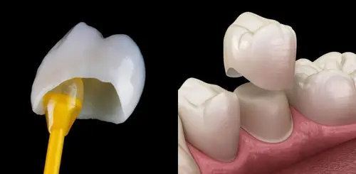 Restorative & Surgical Care Two images side by side showing a dental crown procedure