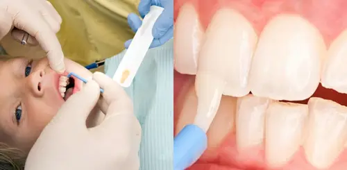 Preventive Care Side by side image of a child receiving fluoride application next to a close up of teeth.