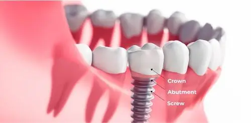 Restorative & Surgical Care Image of dental implant labeling each part of the implant.