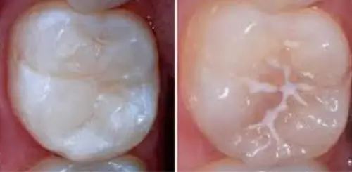 Preventive Care Close up image of a tooth after a dental sealant procedure.