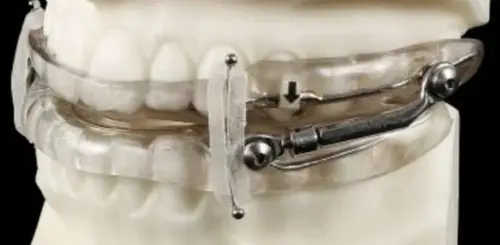 Appliance Therapy Image of a sleep apnea device on a dental stone model