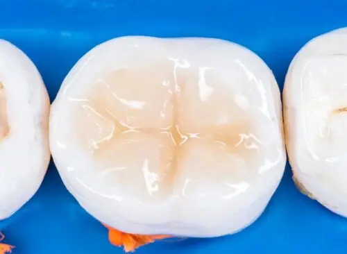 Restorative & Surgical Care Picture of tooth following a composite filling procedure