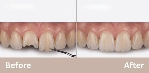 Cosmetic Services Before and After image showing chipped tooth repair using dental bonding.