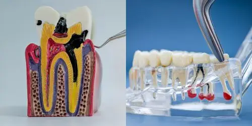 Restorative & Surgical Care Two dental models displaying tooth decay requiring a root canal.