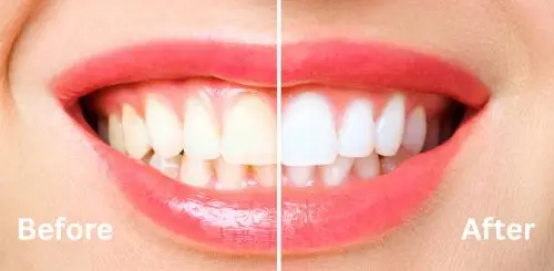 Cosmetic Services Before and after results of a professional teeth whitening procedure.